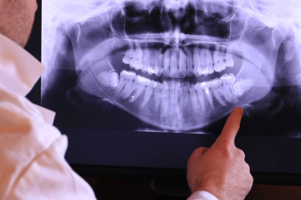 Best Emergency Dental Extractions in Malaga, NJ